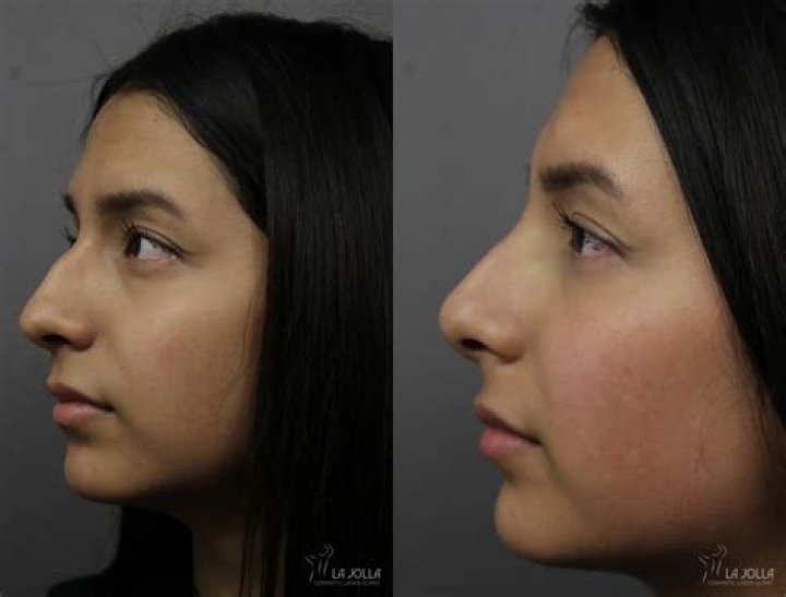 Tomi Lahren Nose Job Before And After Photos, Botox Plastic Surgery